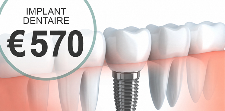 Implant Dentaire